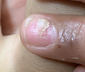 （爪甲剥離症）手足口病発症後の写真、１か月くらいたってから子供の爪の表面が剥がれる症状が出た